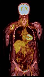 PET CT